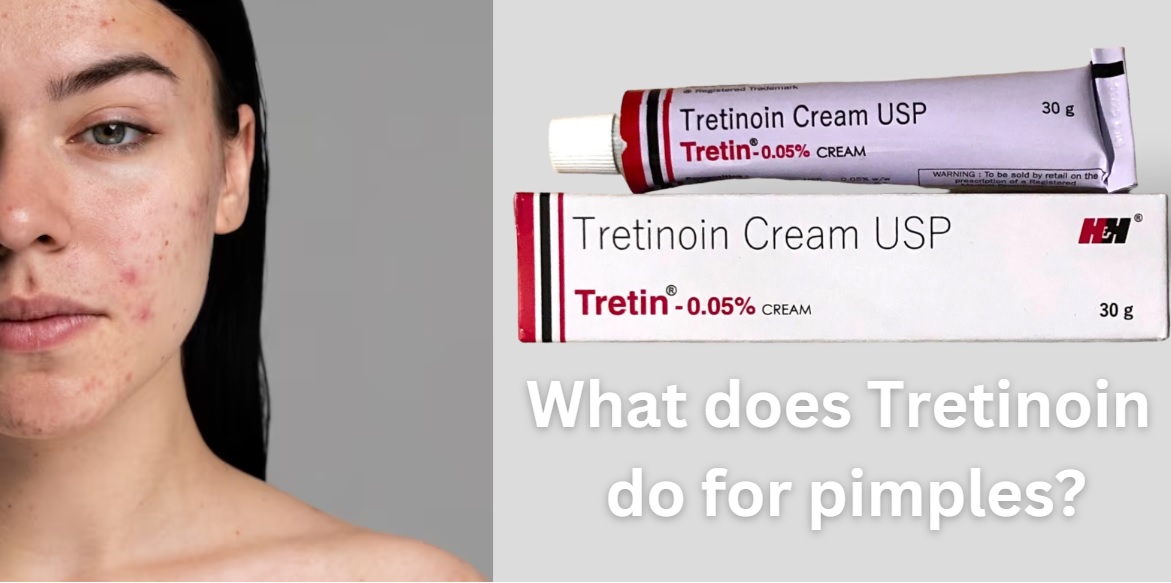 What does Tretinoin do for pimples?